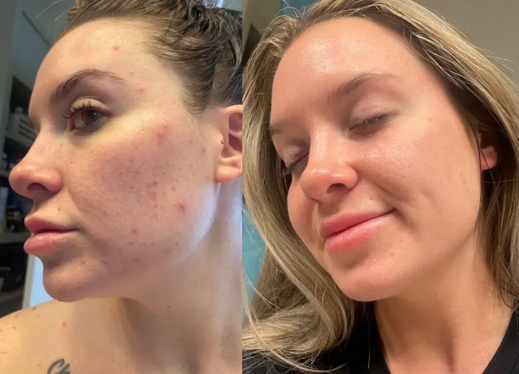 | BBL Forever Clear Before and After Images | Lou Lou Med Spa