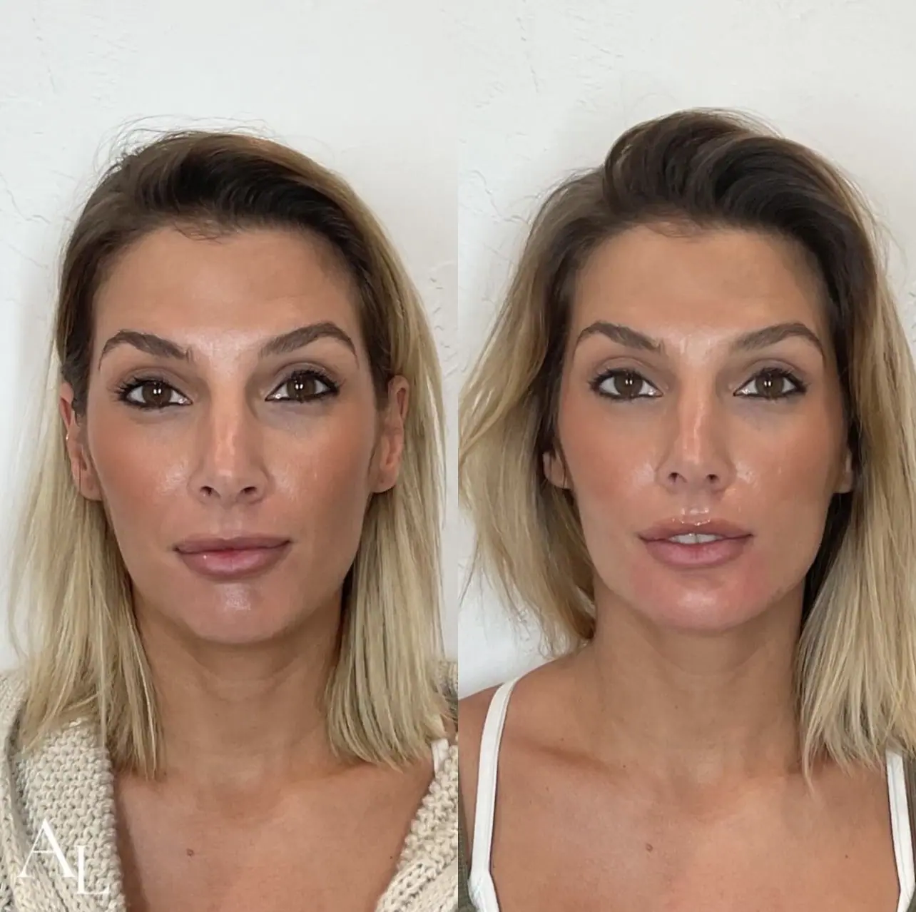 Chin Filler Before And After Images LOU LOU MED SPA Chin Filler Before And After Images LOU LOU MED SPA
