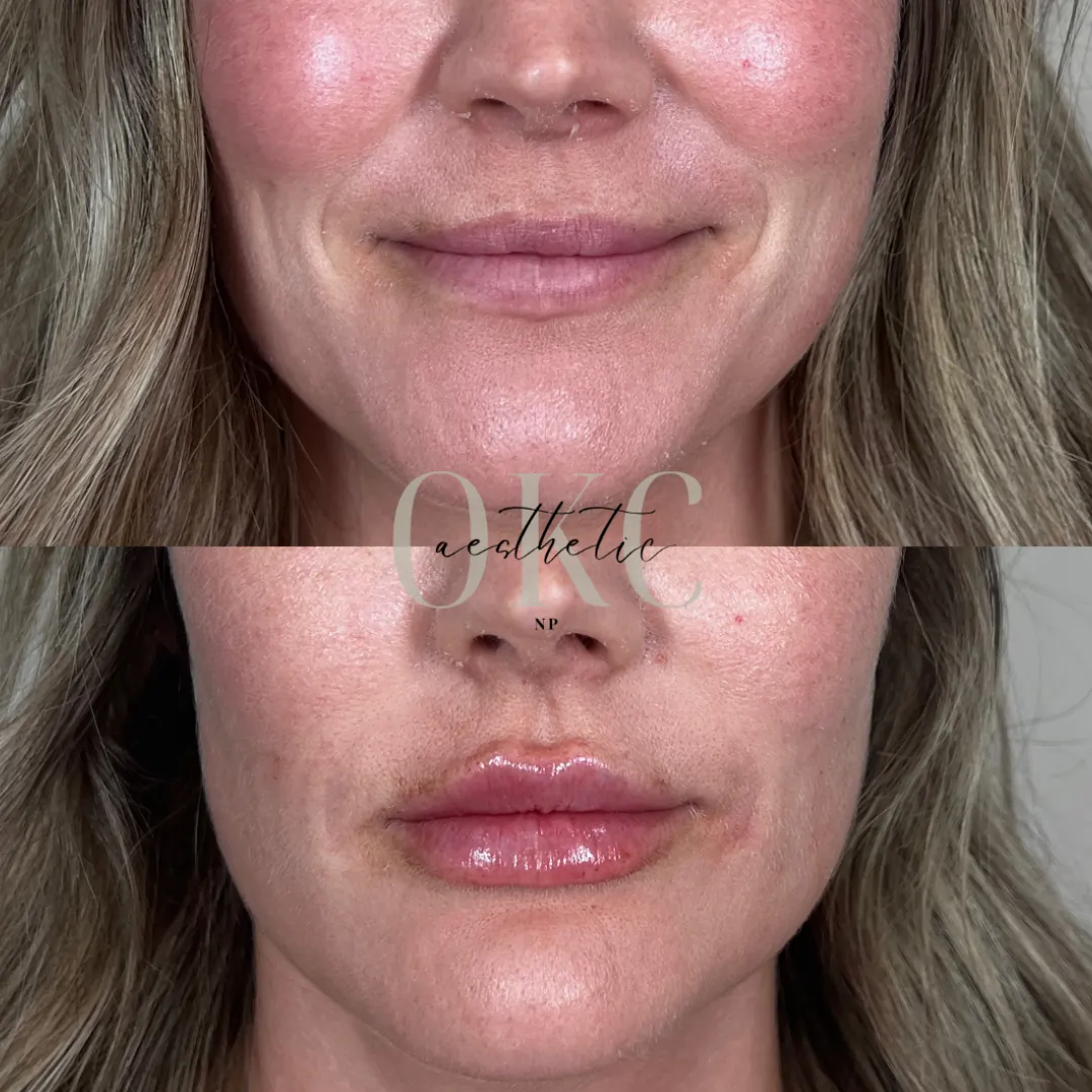 | Lip Filler Results | Lou Lou Med Spa