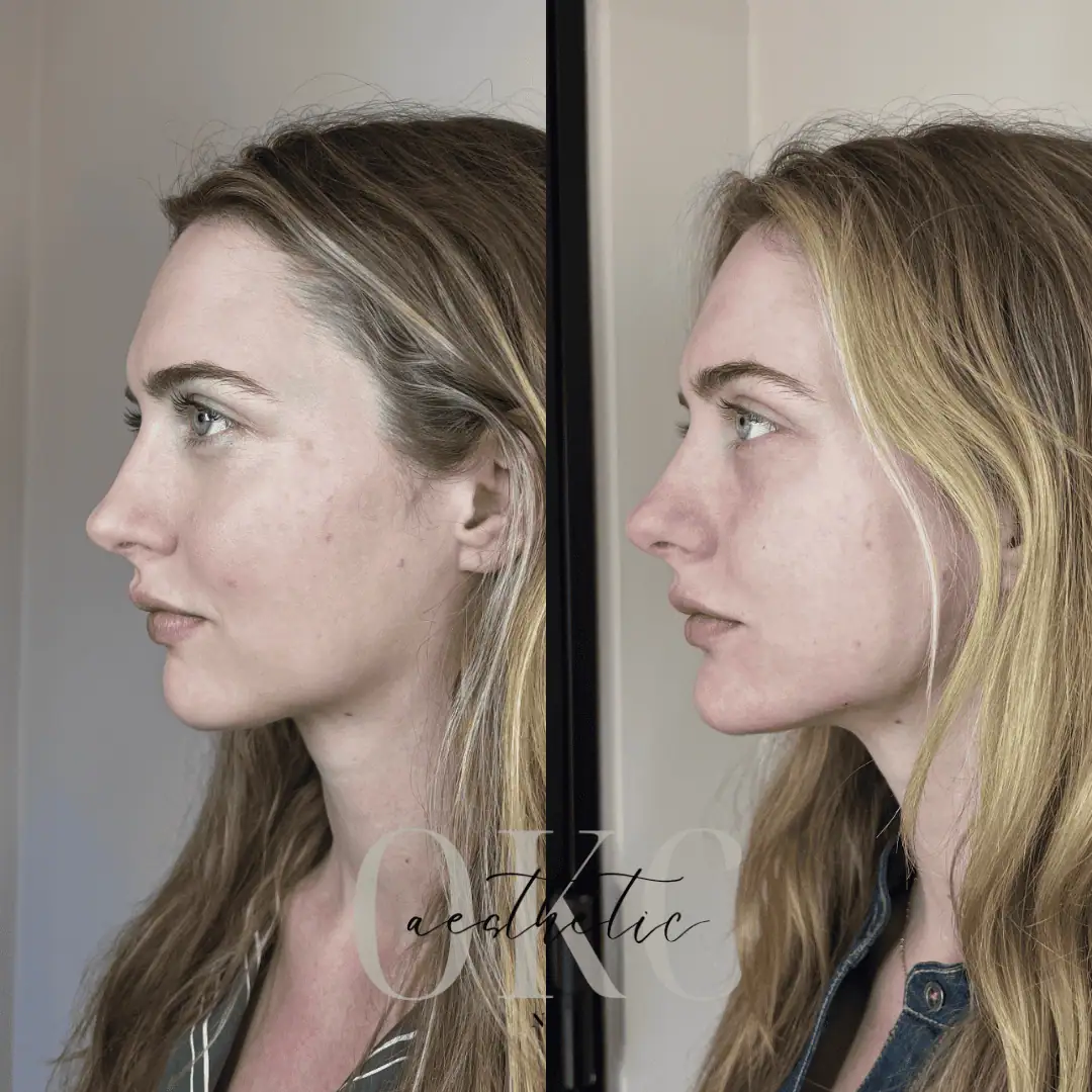 Chin Filler Result