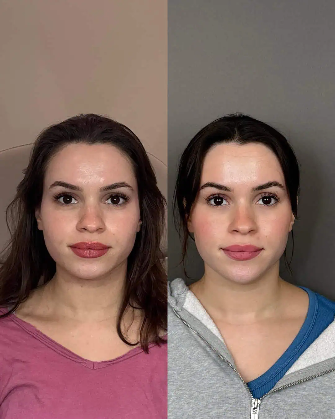 chin filler