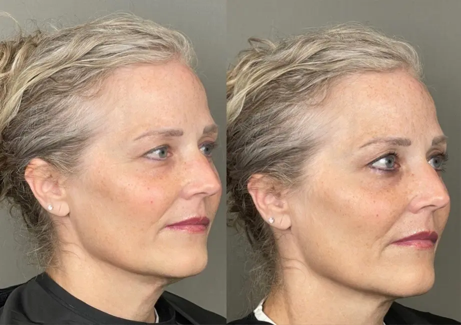 before and after