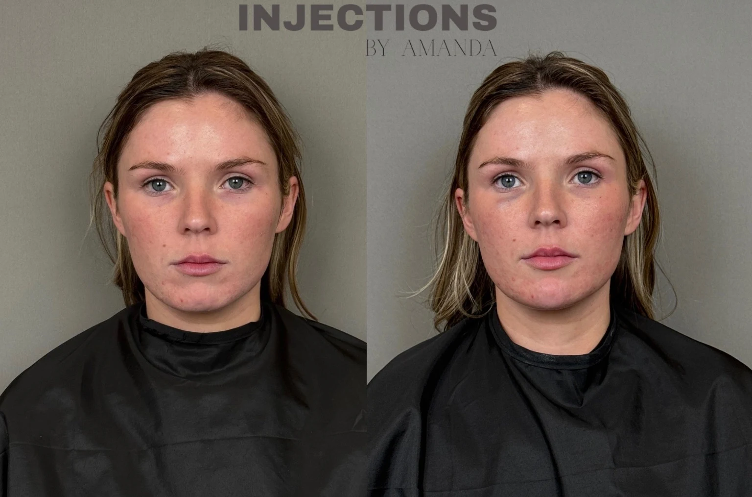 Chin Filler Before and After Images - 12 Chin Filler (2)