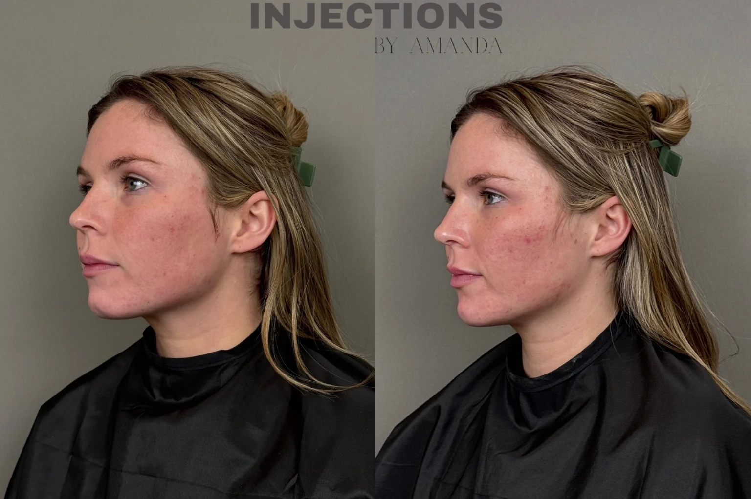 Chin Filler Before and After Images - 13 Chin Filler (3)