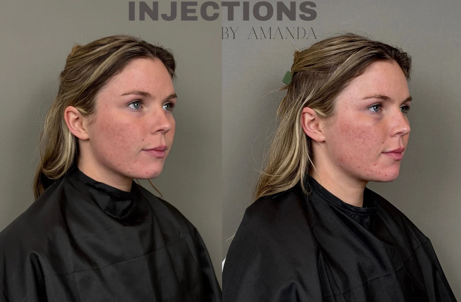 Chin Filler Before and After Images - 11 Chin Filler