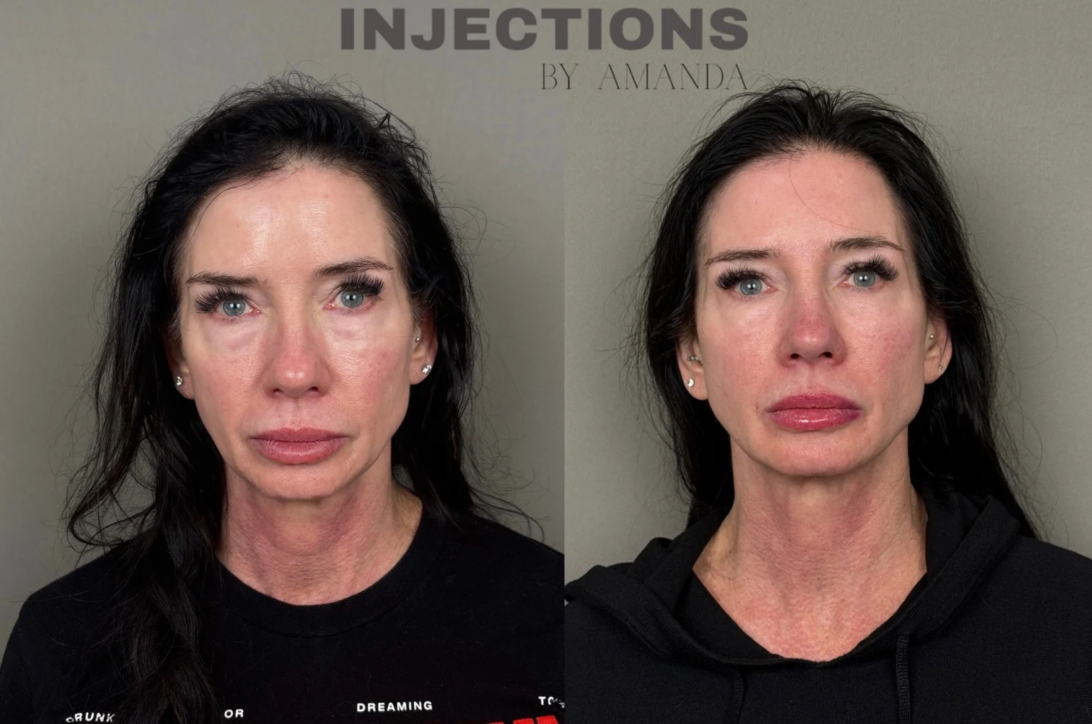 Hyperdilute Radiesse Results - 5 Hyperdilute Radiesse (2)