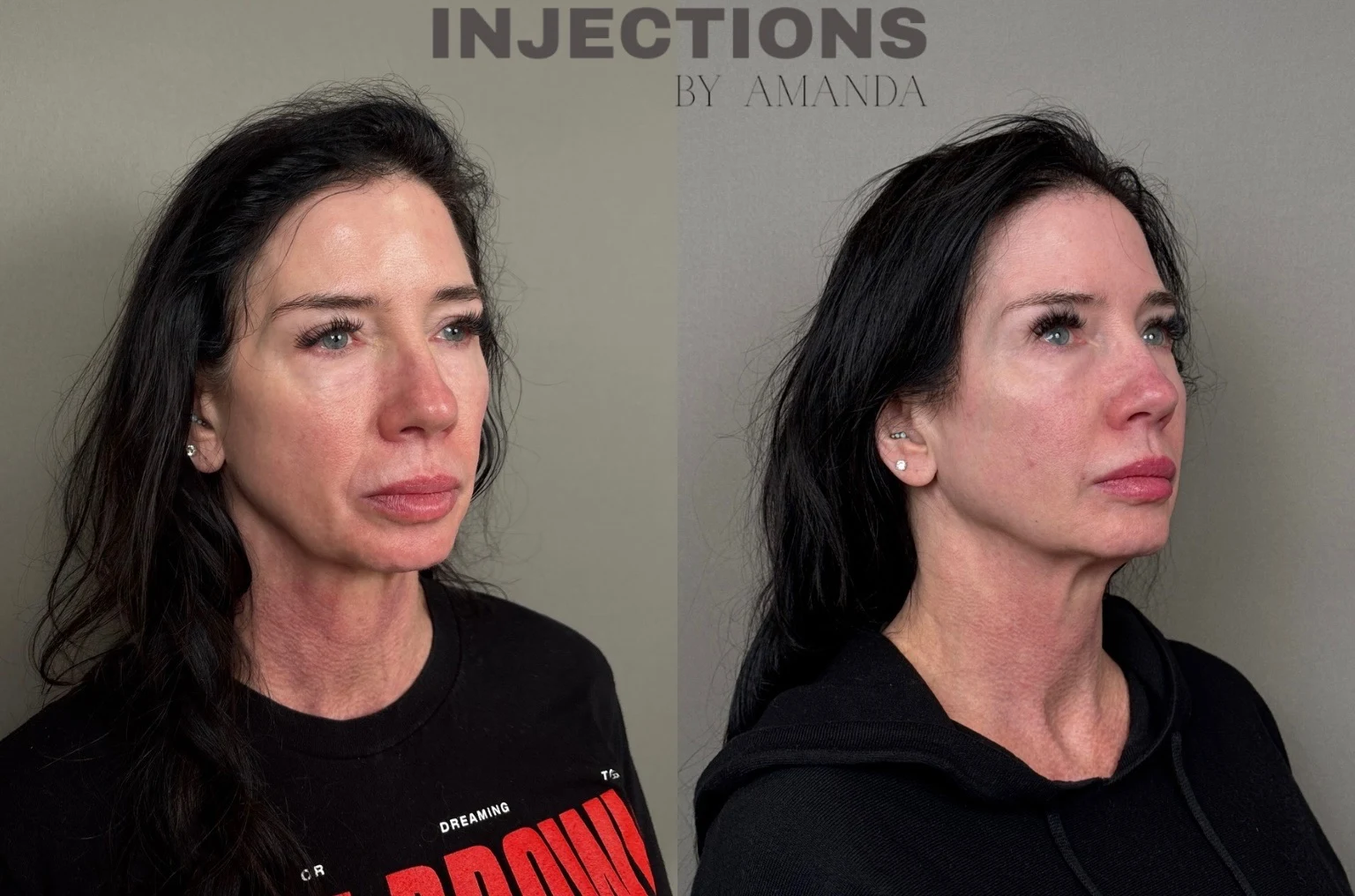 Hyperdilute Radiesse Results - 4 Hyperdilute Radiesse