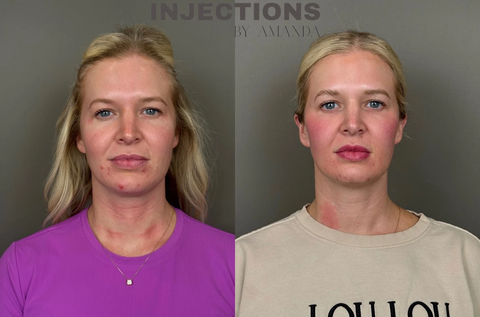 Youthful Essence Before and After Images - 5 Youthful Essence (2)