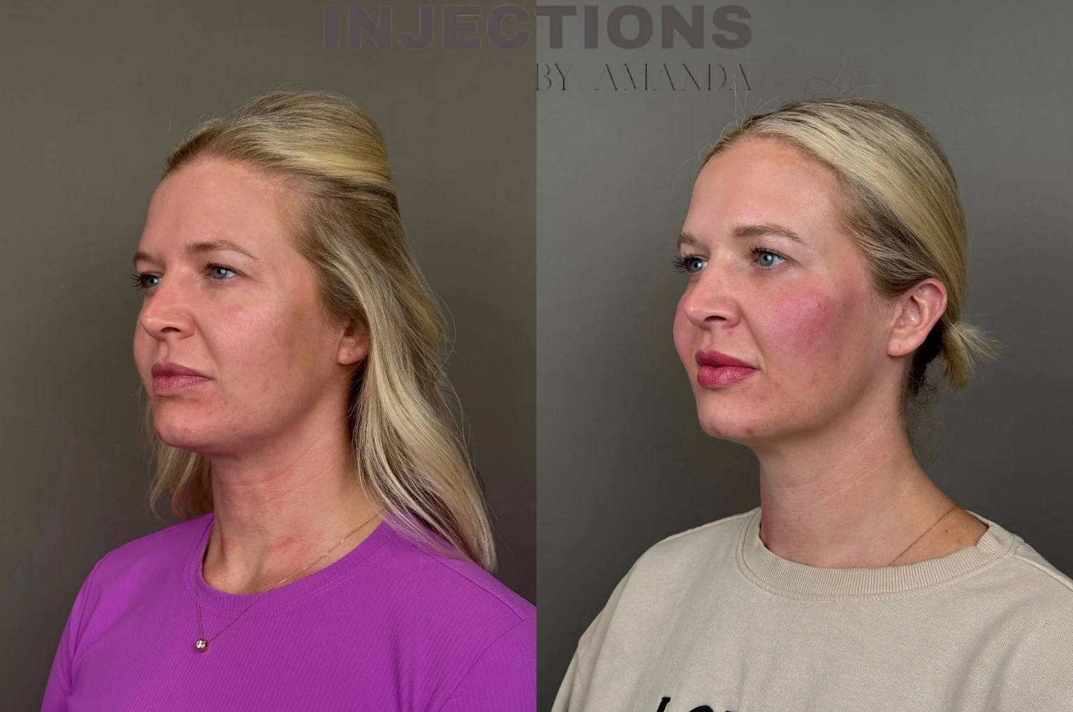 Youthful Essence Before and After Images - 6 Youthful Essence (3)