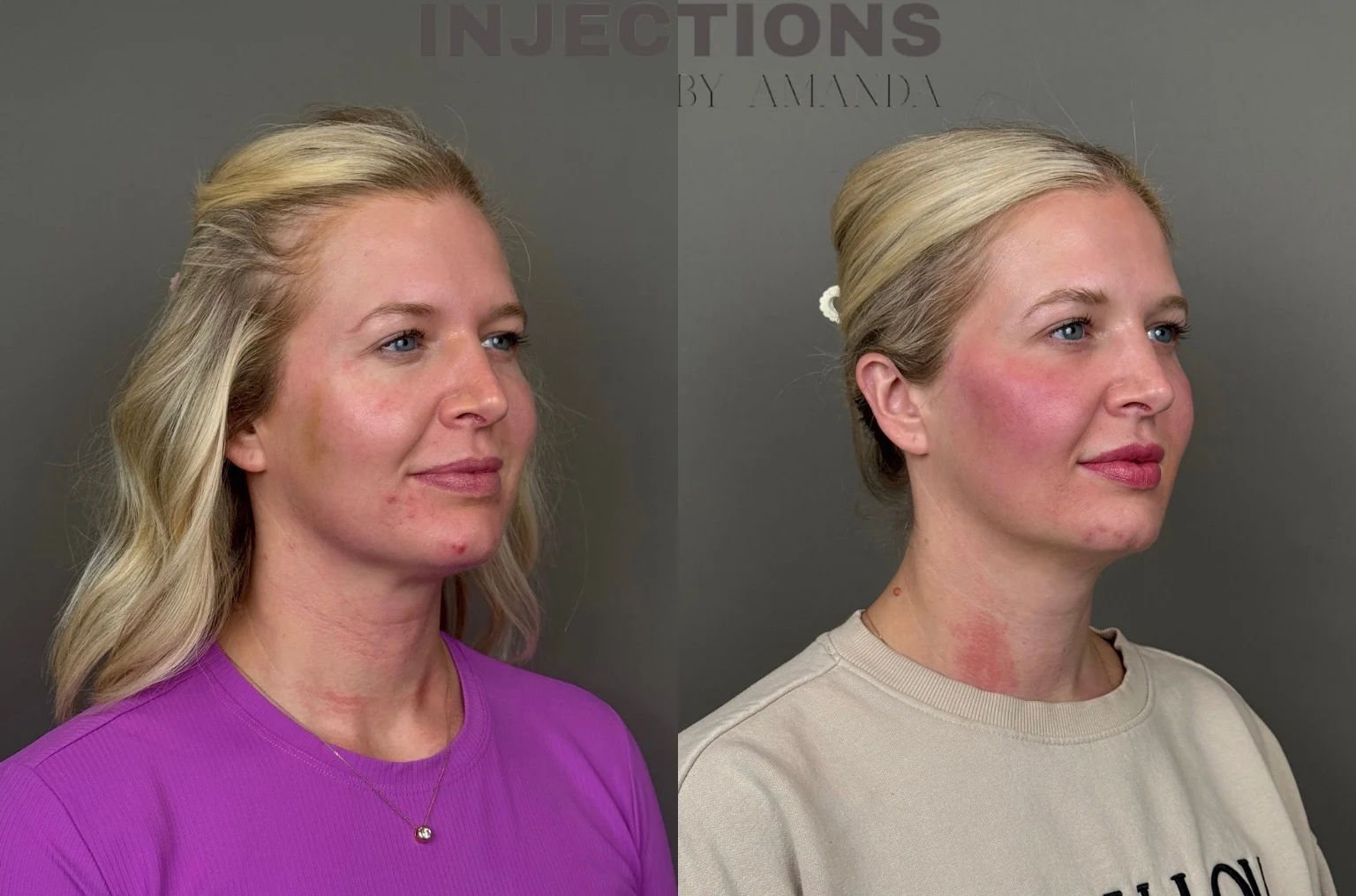 Youthful Essence Before and After Images - 4 Youthful Essence