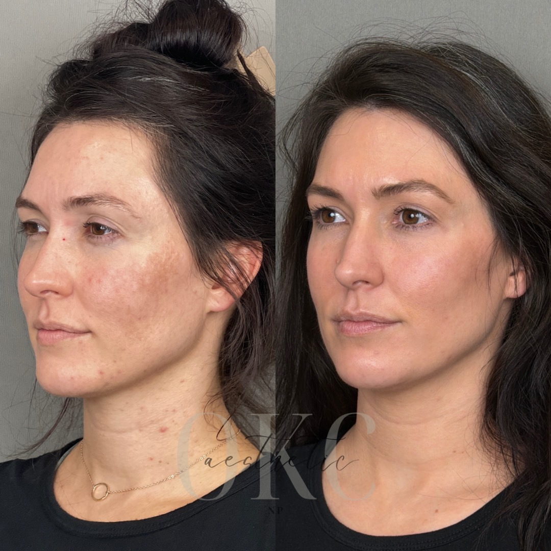 MEDICAL SKINCARE Before and After Images - LOU LOU MED SPA