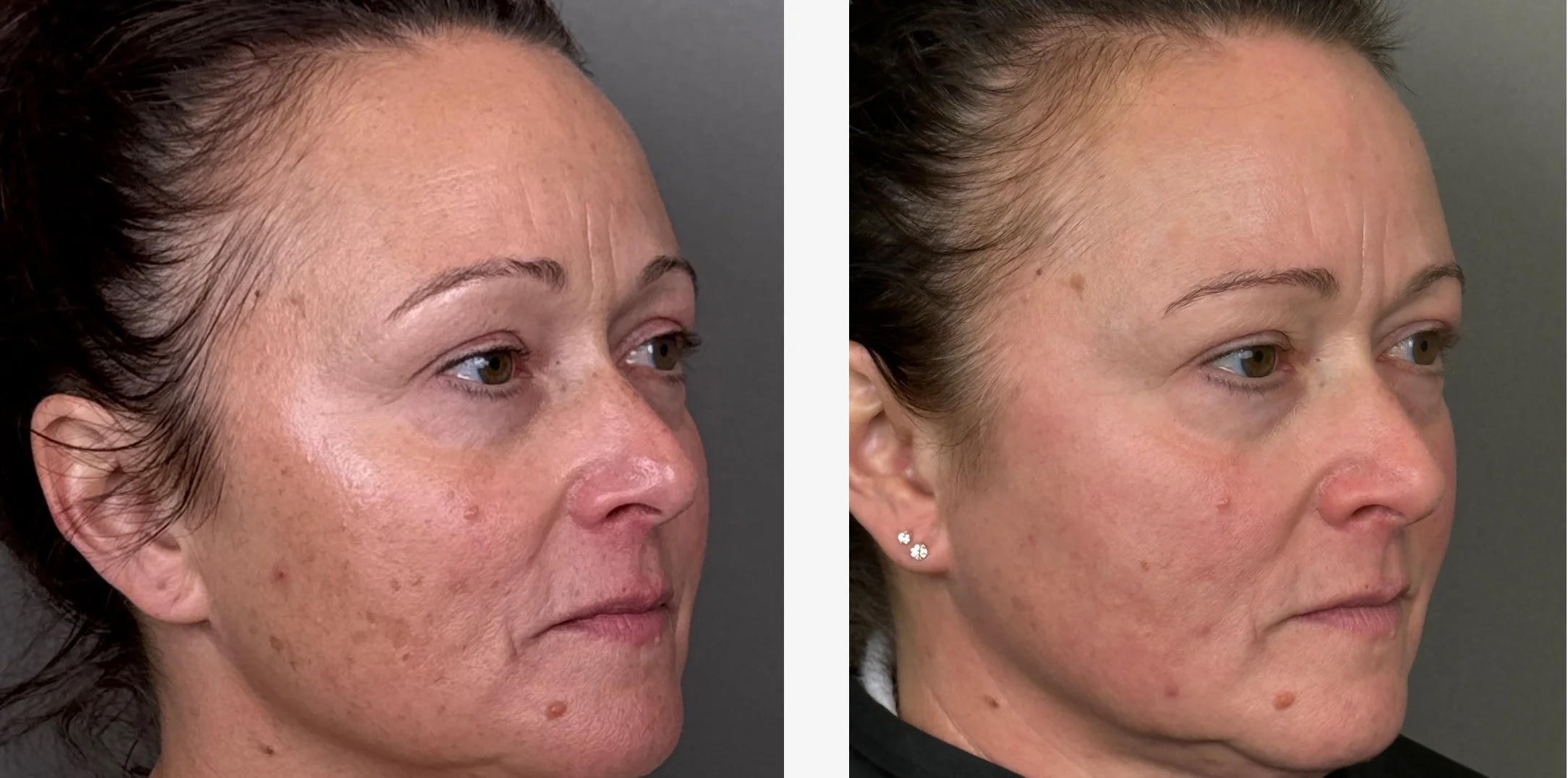 MEDICAL SKINCARE Before and After Images - 14 Custom ZO Skin Health Regiment