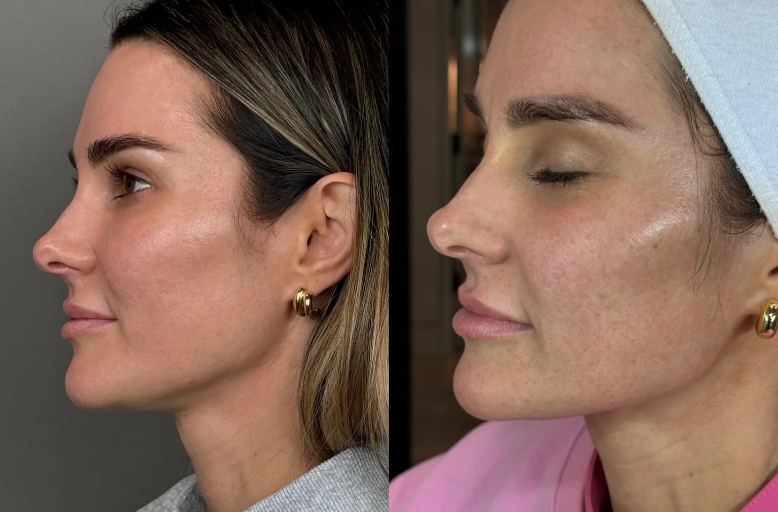 HALO Results: Before & After Image - 10 HALO Face Neck and Decolette