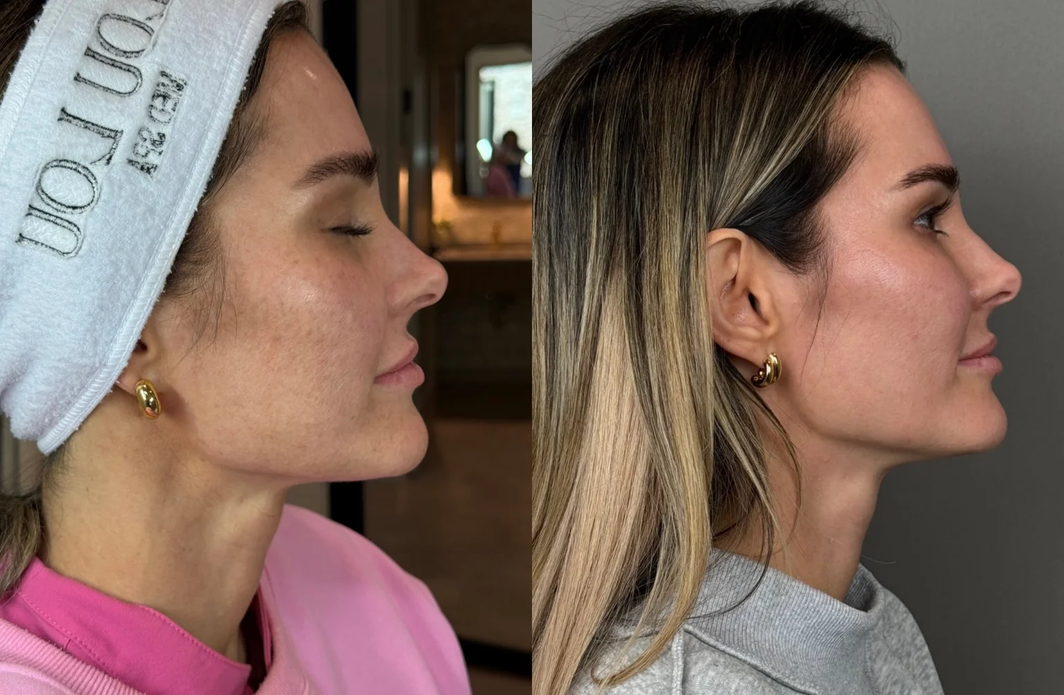 HALO Results: Before & After Image - 9 HALO Face Neck and Decolette