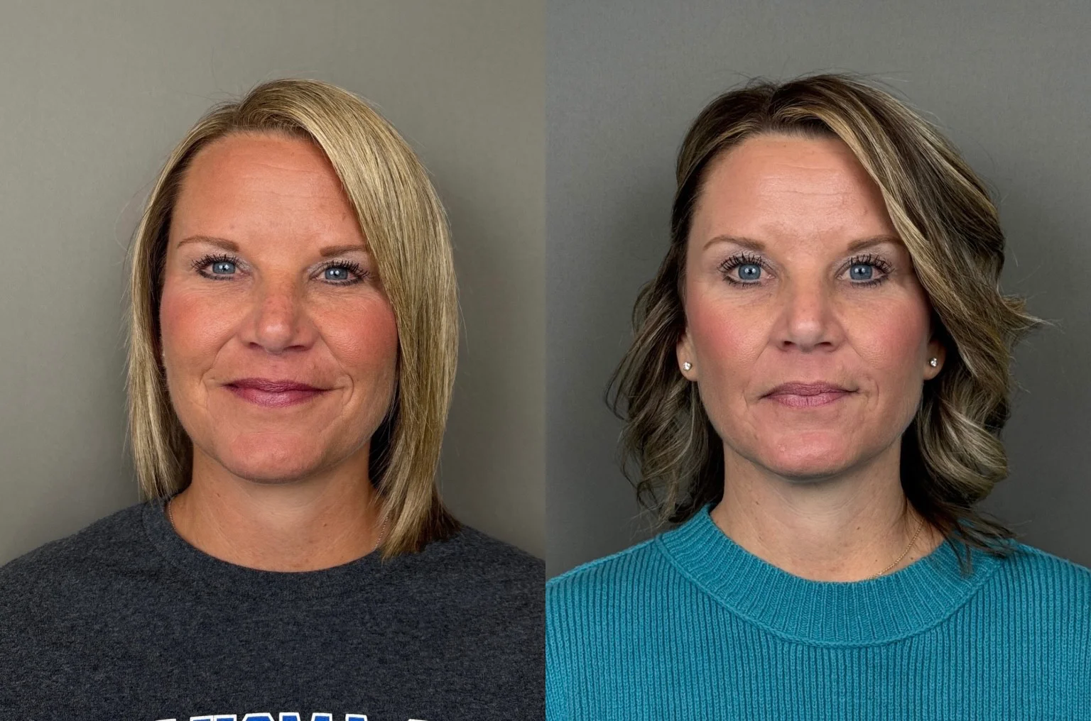 Contour TRL - 2 Contour TRL Deep Resurfacing (peri-oral)