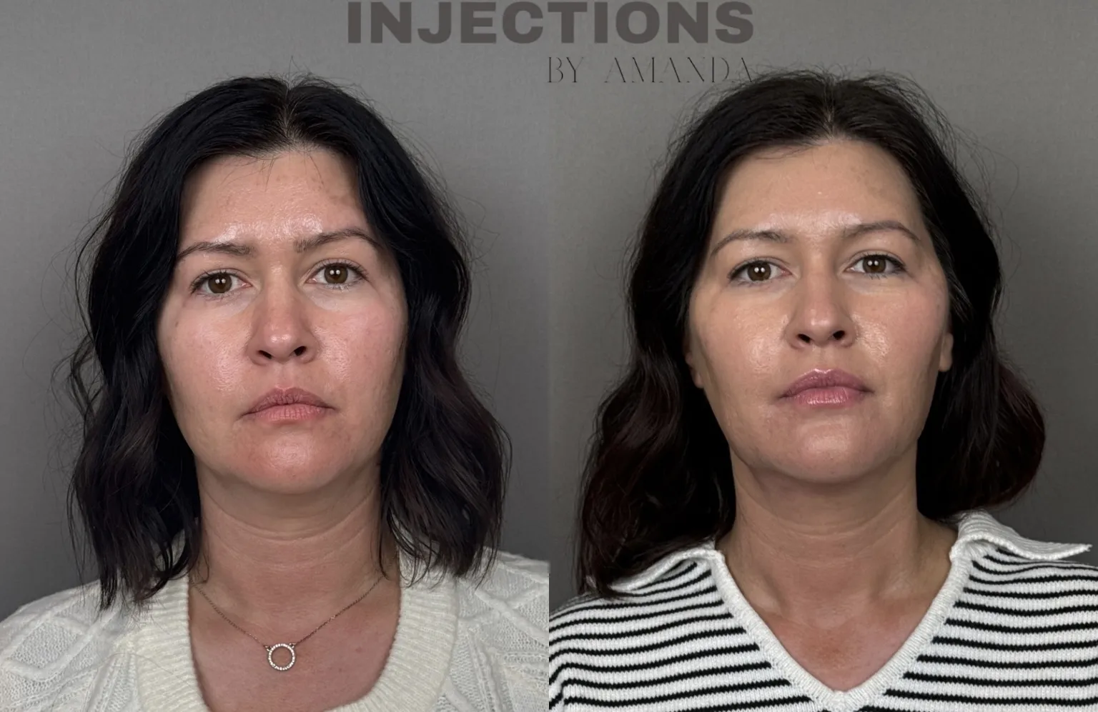 Hyperdilute Radiesse Results - 5 Hyperdilute Radiesse ..