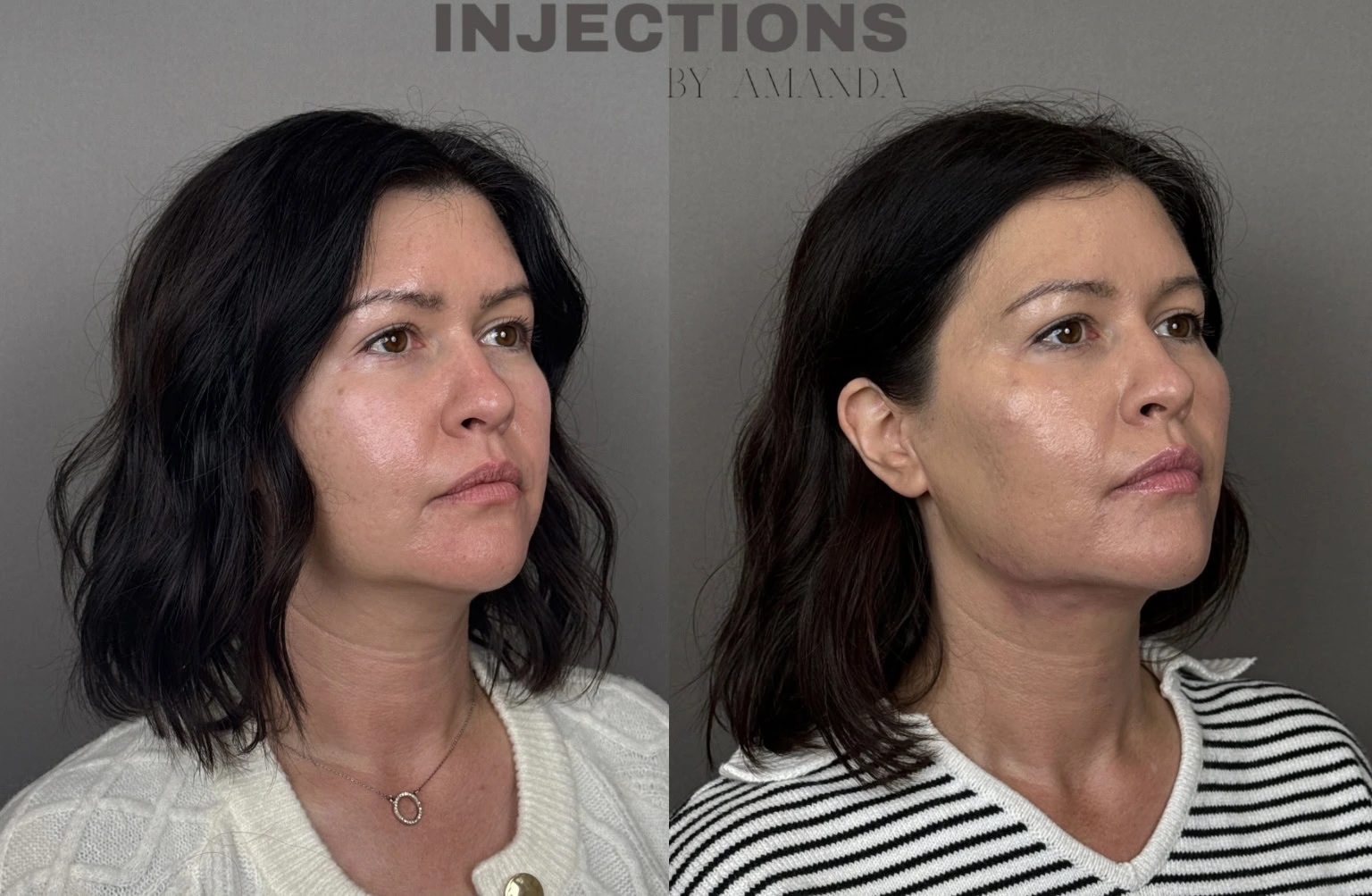 Hyperdilute Radiesse Results - 4 Hyperdilute Radiesse