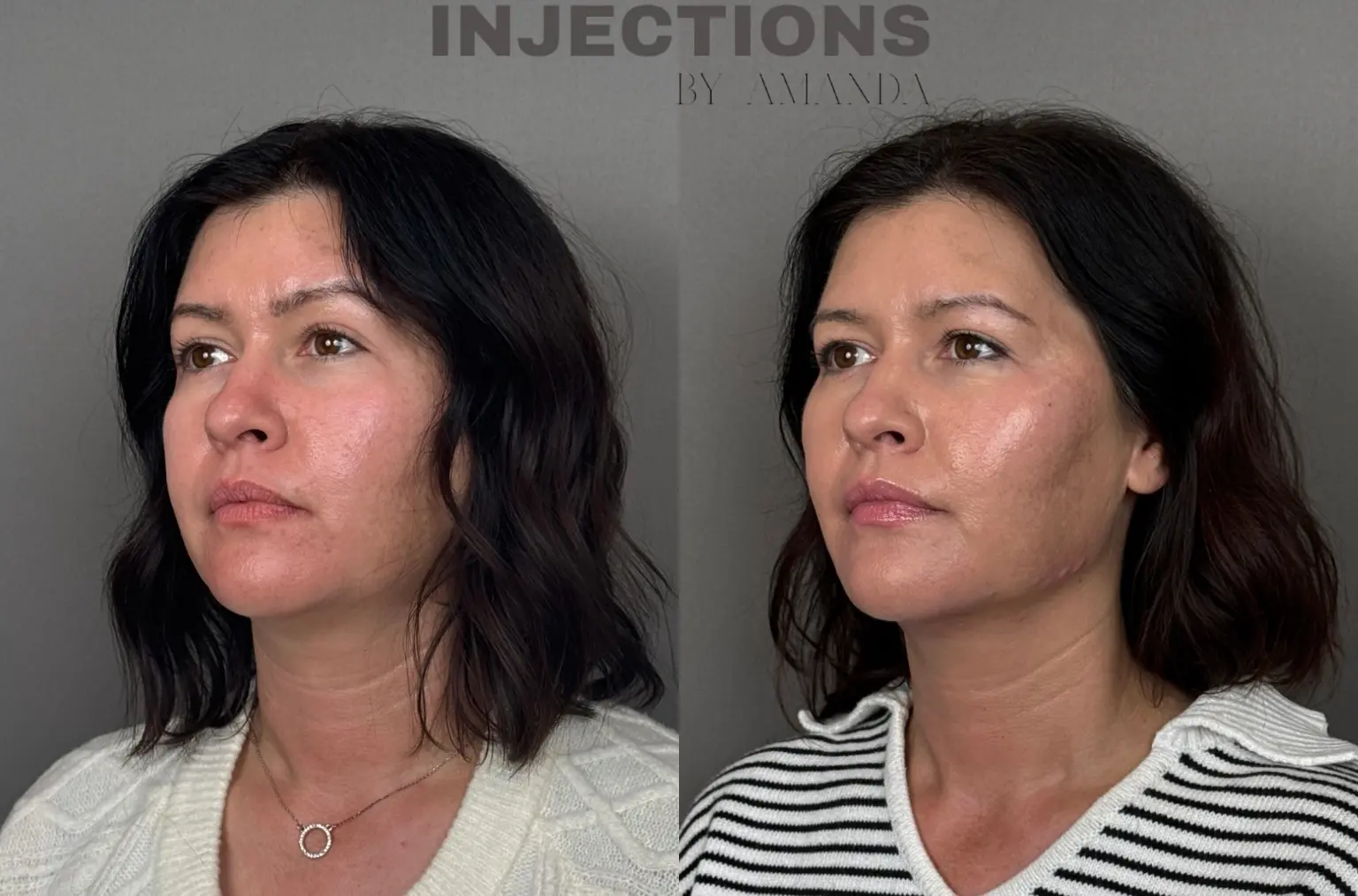 Hyperdilute Radiesse Results - 6 Hyperdilute Radiesse1-2