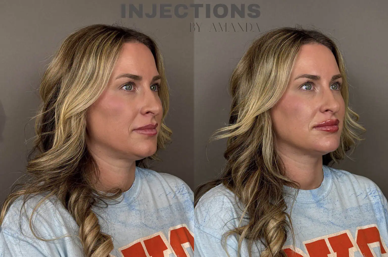 Perfect Profile Package Before and After Images - 2 Perfect Profile 1b