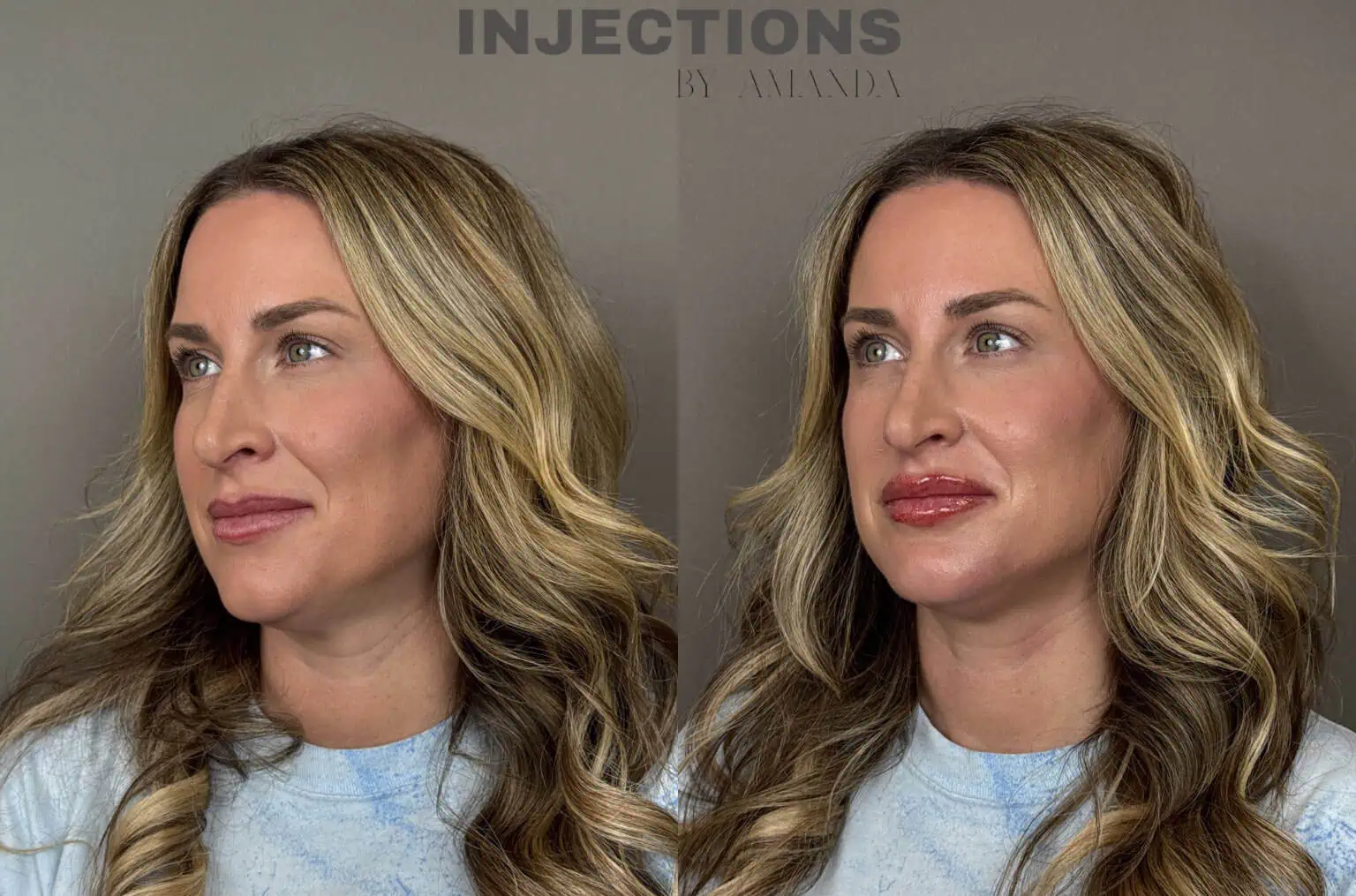 Perfect Profile Package Before and After Images - 1 Perfect Profile 1c