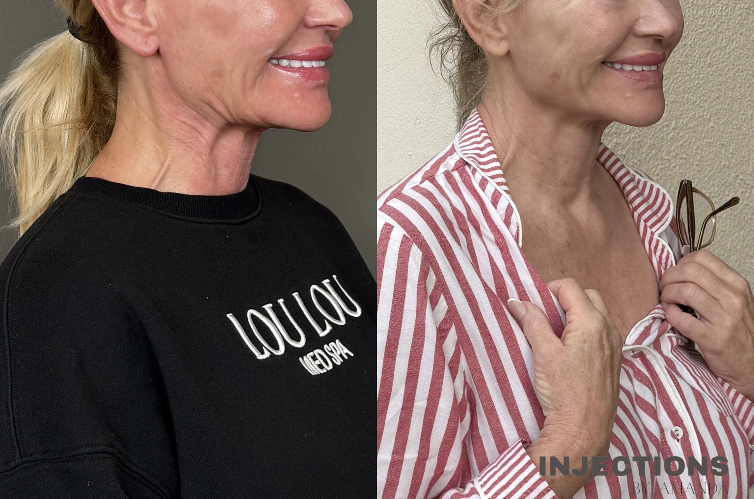 Hyperdilute Radiesse Results - 3 Regenerative Neck Package 1