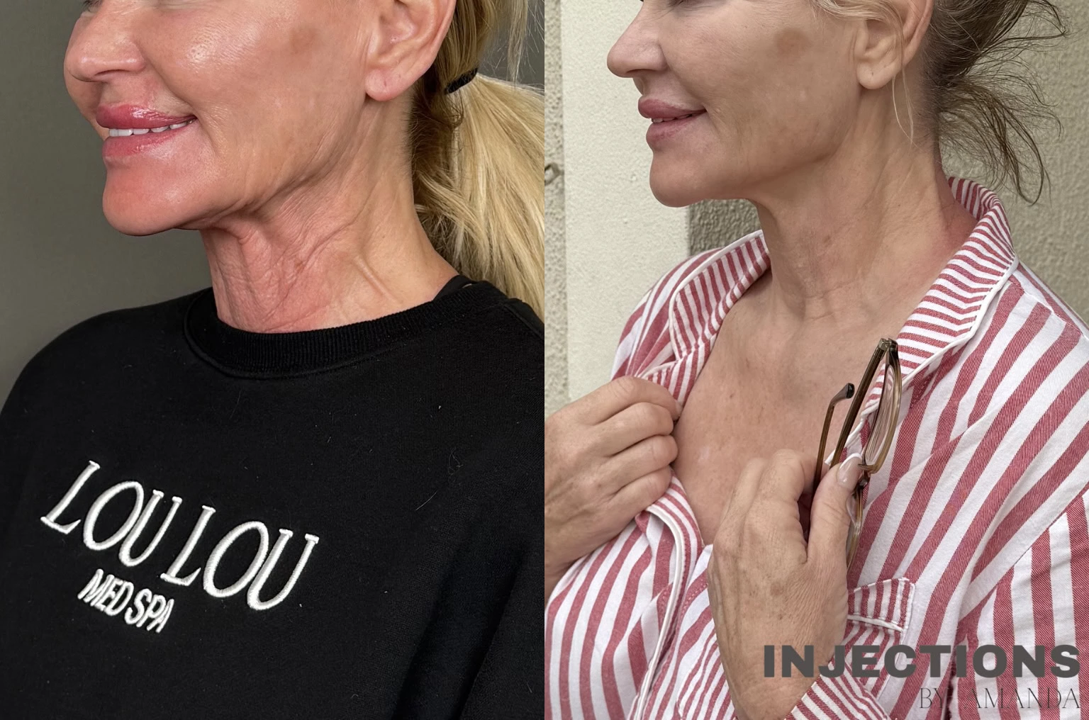 Hyperdilute Radiesse Results - 1 Regenerative Neck Package 2