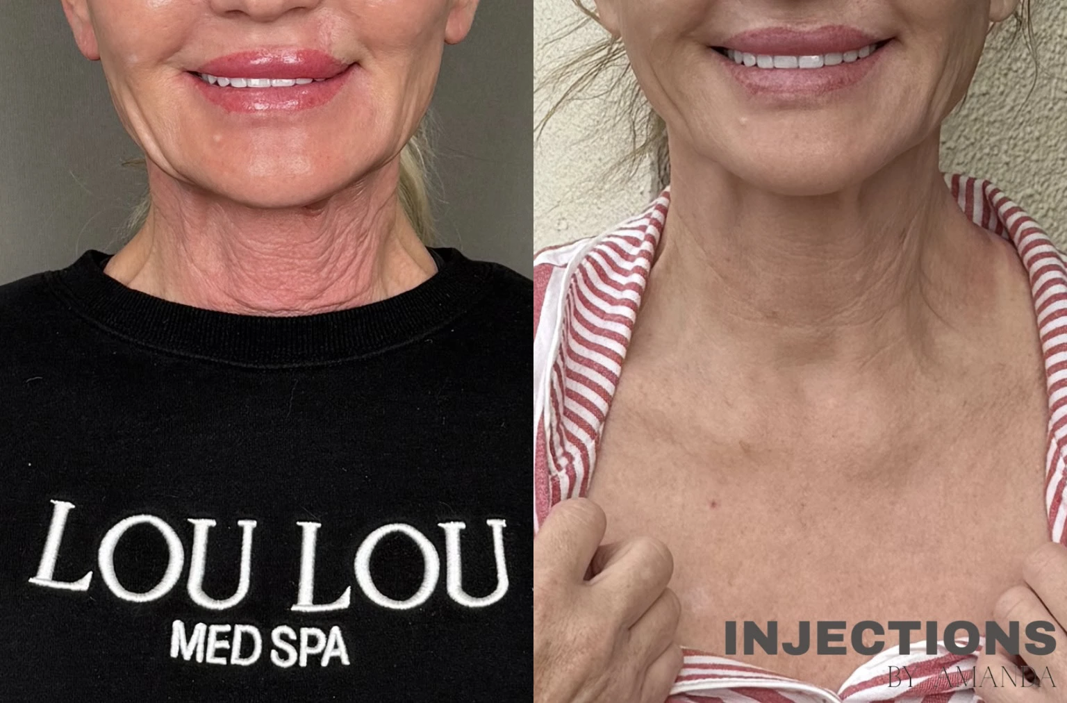 Hyperdilute Radiesse Results - 2 Regenerative Neck Package