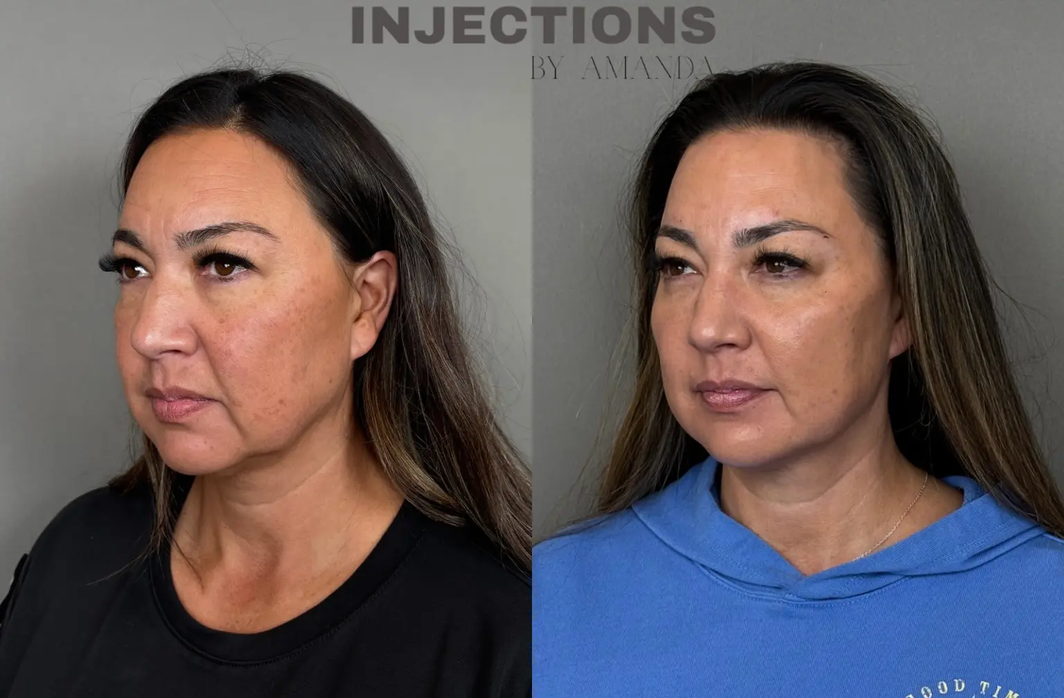 Facial Harmony Trio Before and After Images - 3 Untitled design (2)