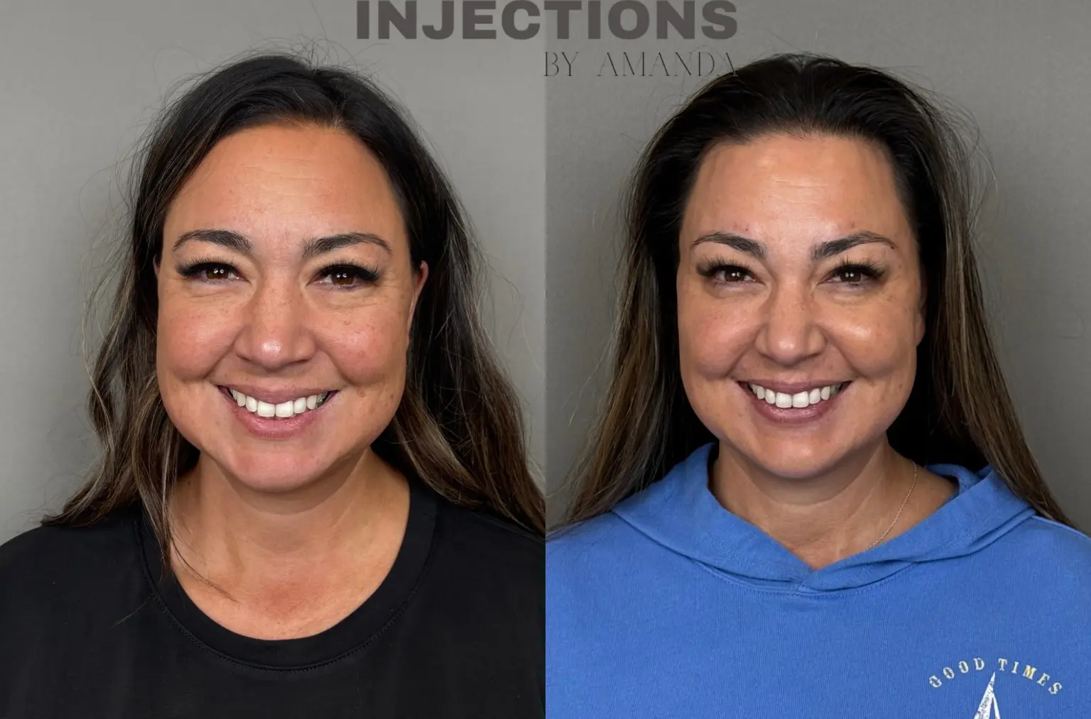 Facial Harmony Trio Before and After Images - 4 Untitled design (3)