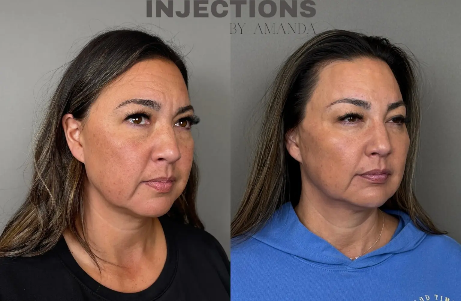 Facial Harmony Trio Before and After Images - 1 Untitled design