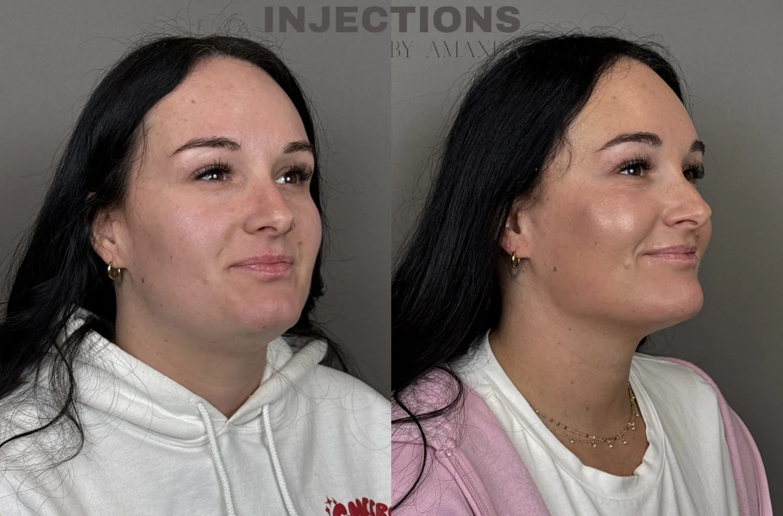 Youthful Essence Before and After Images - 1 Youthful Essence1