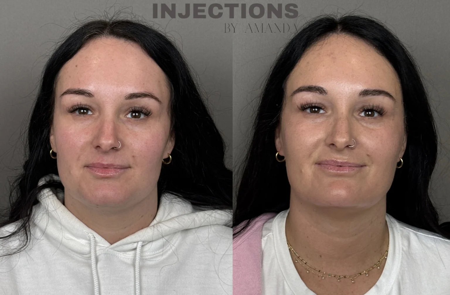 Youthful Essence Before and After Images - 2 Youthful Essence2