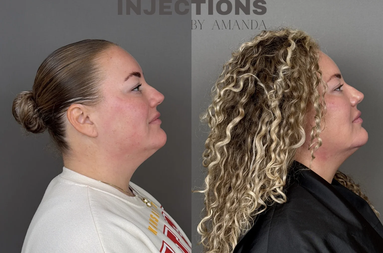Chin Filler Before and After Images - 4 Chin Filler1