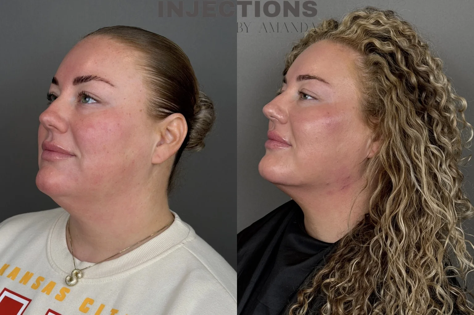 Chin Filler Before and After Images - 5 Chin Filler2