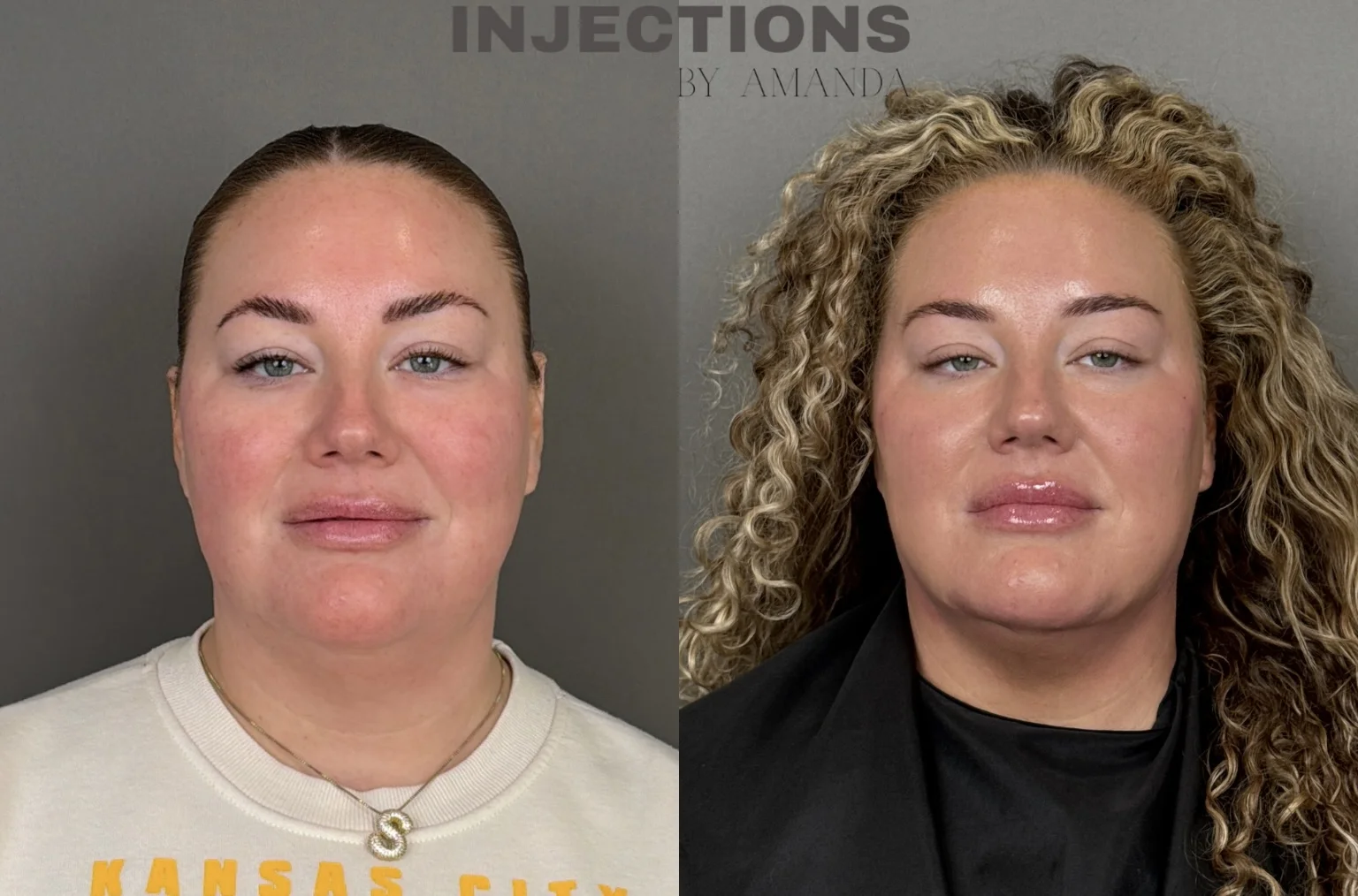Chin Filler Before and After Images - 6 Chin Filler3