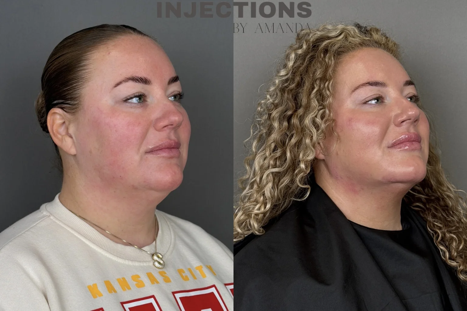 Chin Filler Before and After Images - 7 Chin Filler4