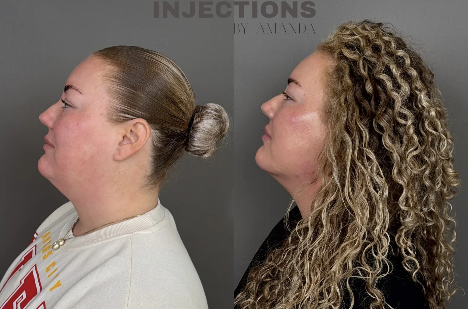 Chin Filler Before and After Images - 8 Chin Filler5
