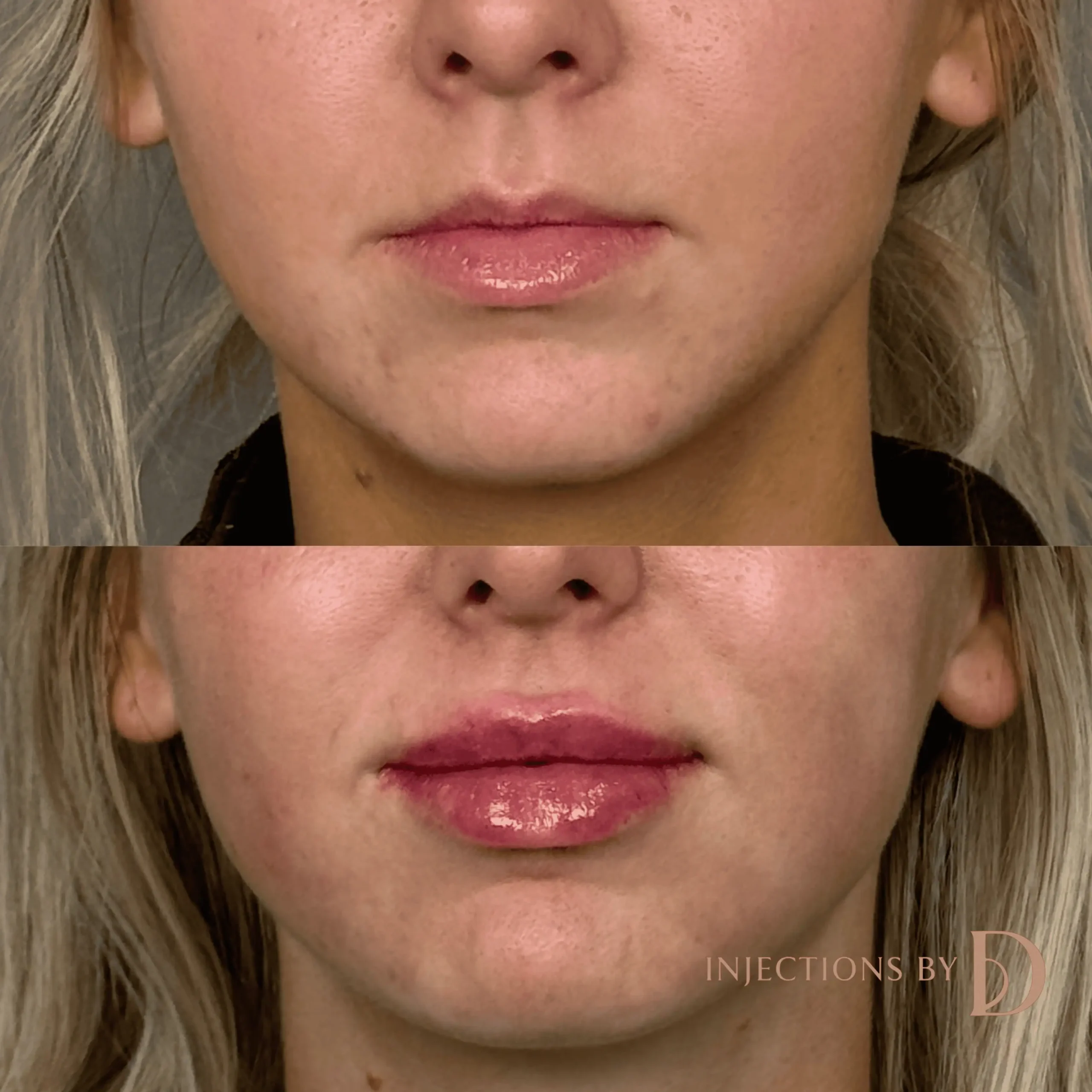 Lip Filler Results - 52 Lip Filler 11