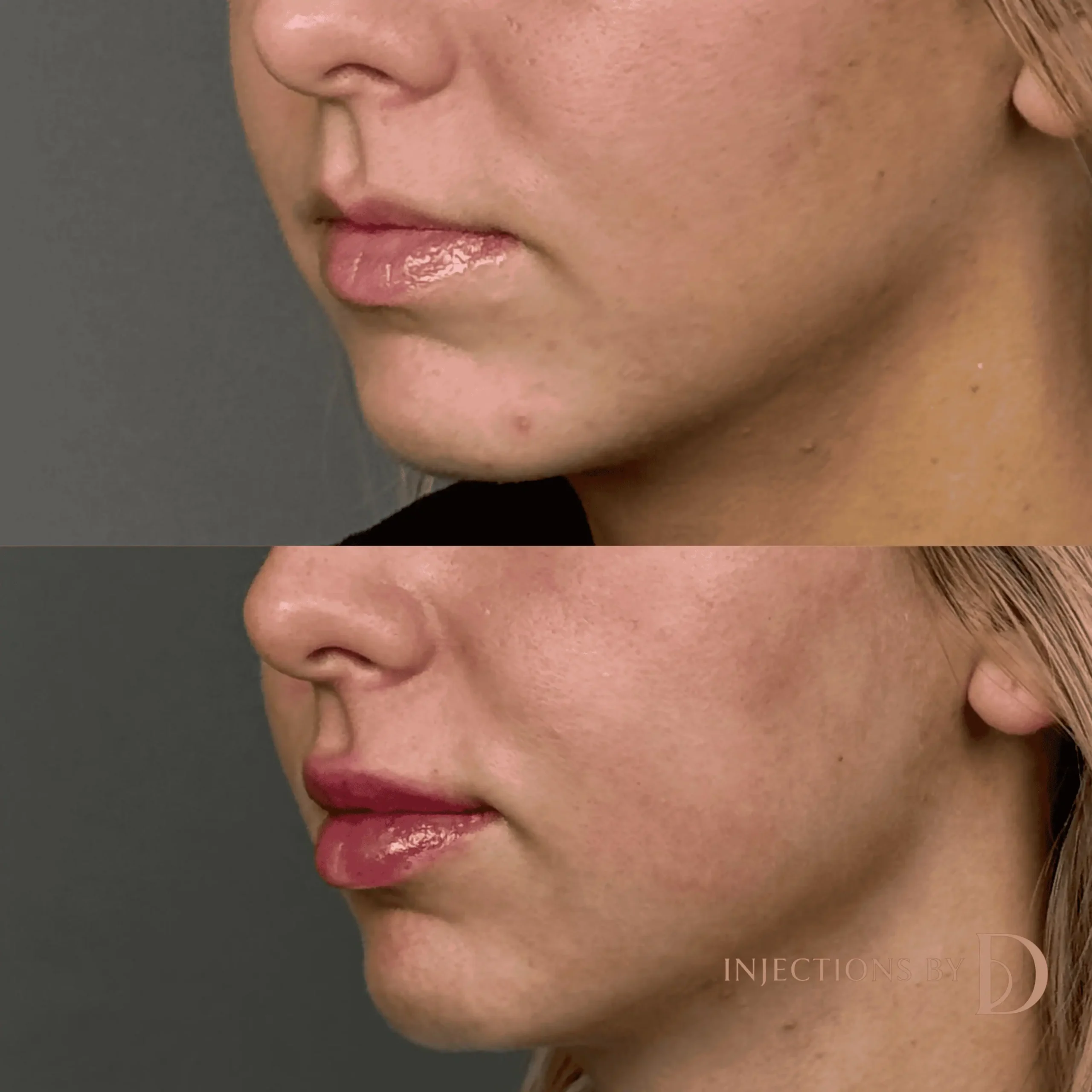 Lip Filler Results - 51 Lip Filler 112