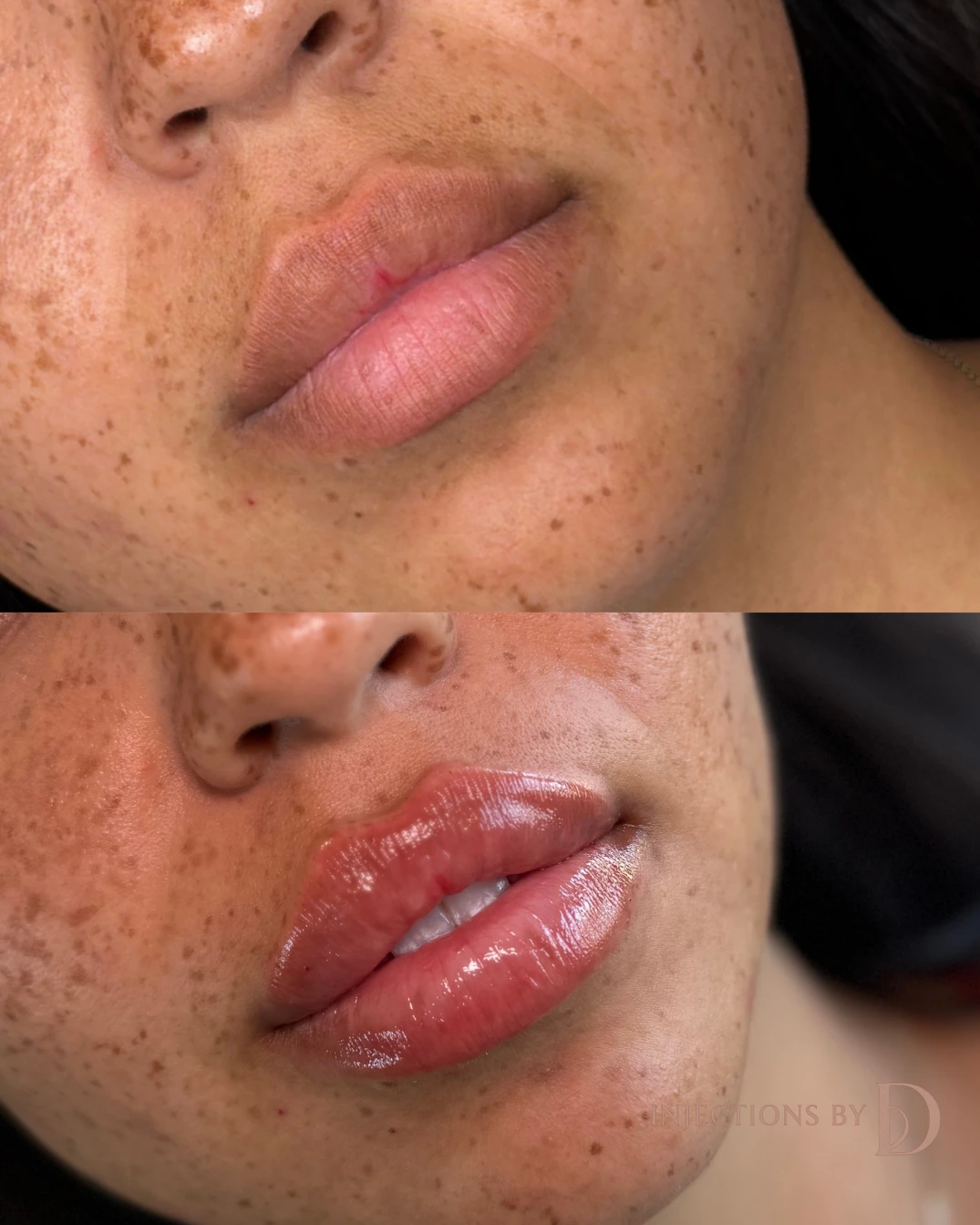 Lip Filler Results - 53 Lip Filler 66