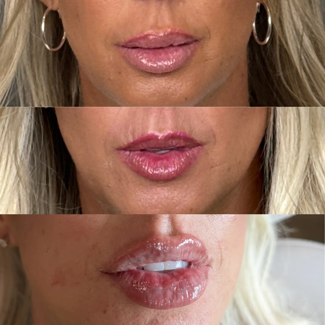Lip Filler Results - 1 Lip Filler