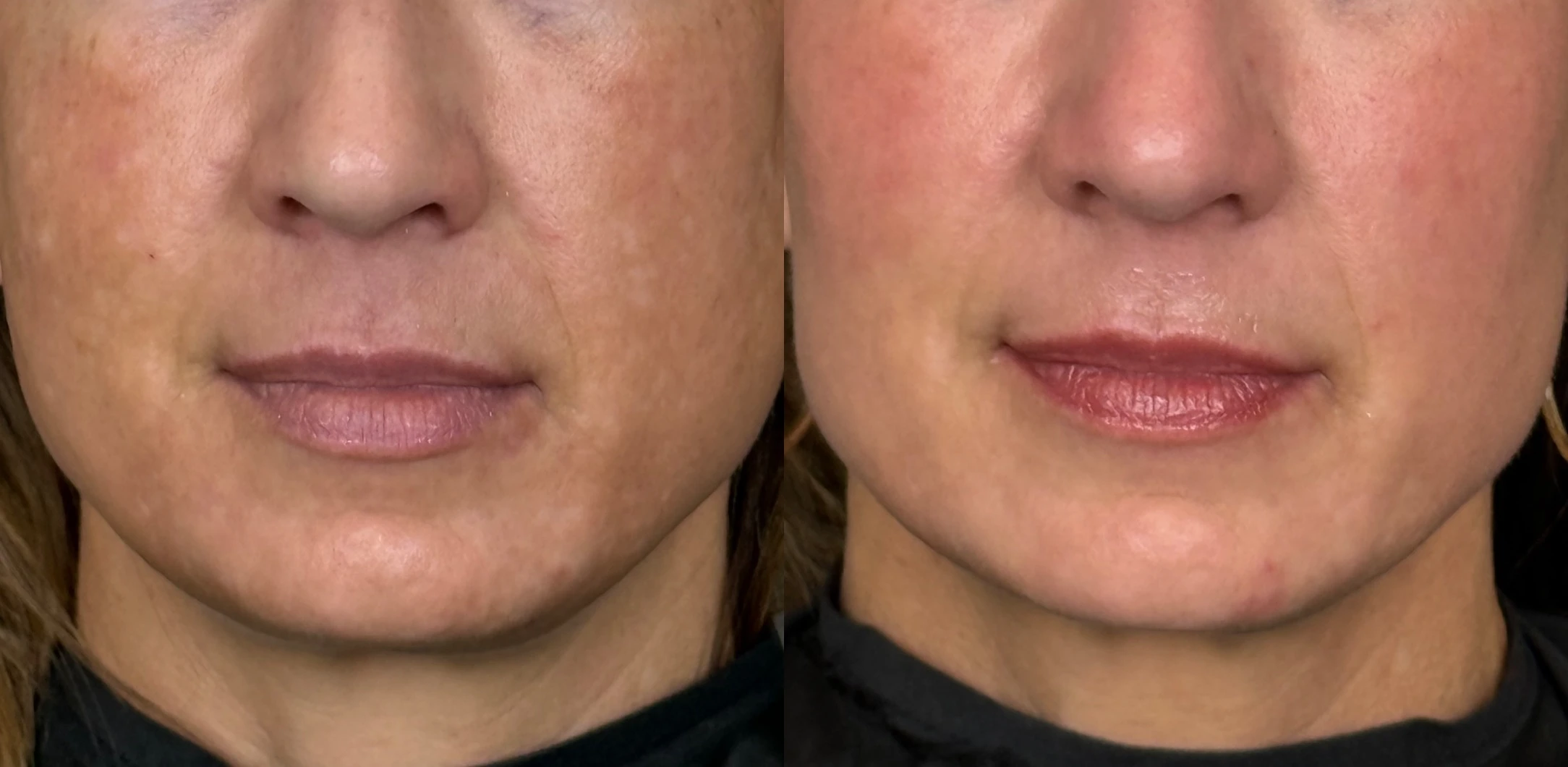 SkinPen Microneedling Before and After Images - 9 SkinPen Face one