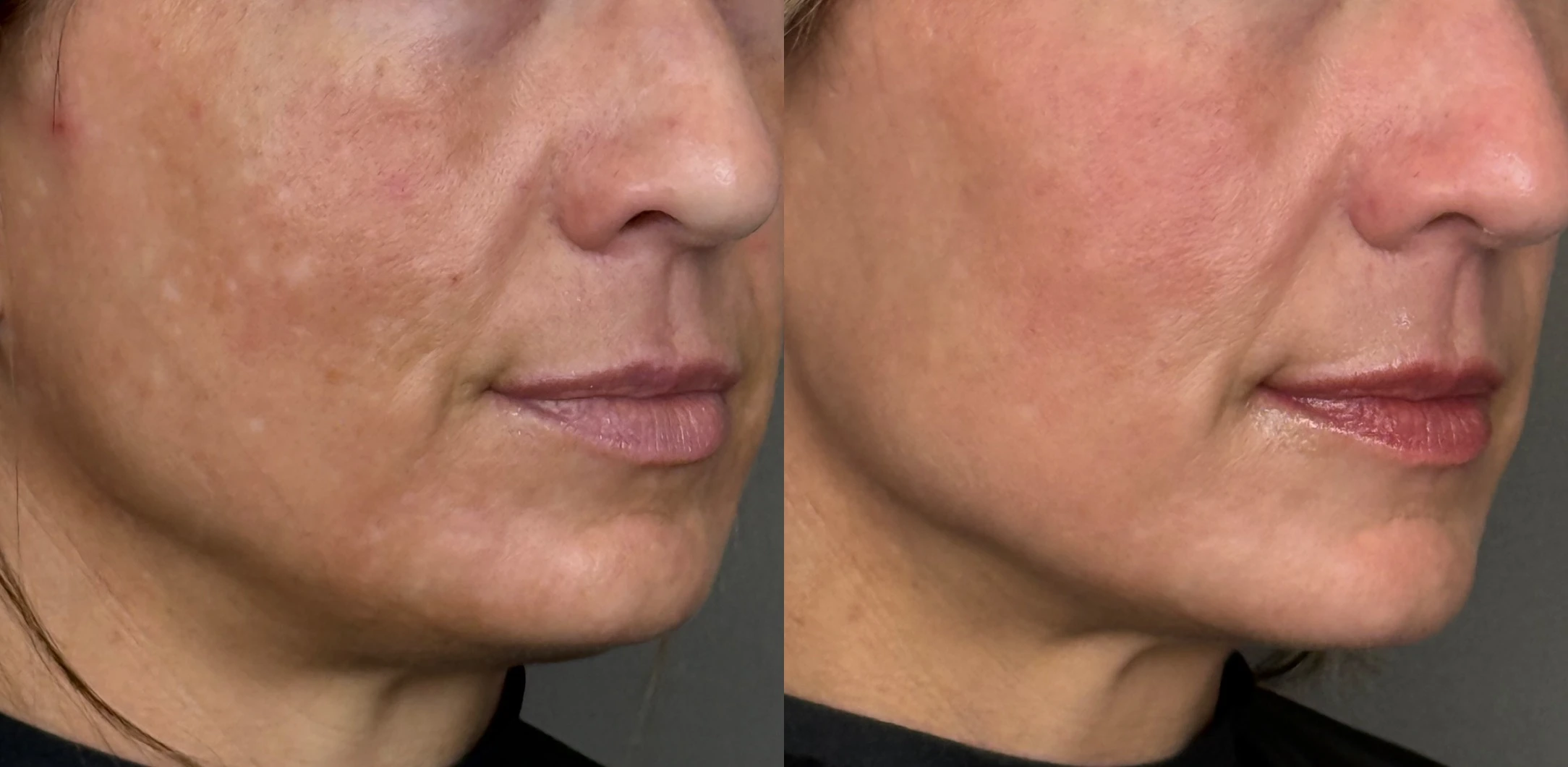SkinPen Microneedling Before and After Images - 10 SkinPen Face two