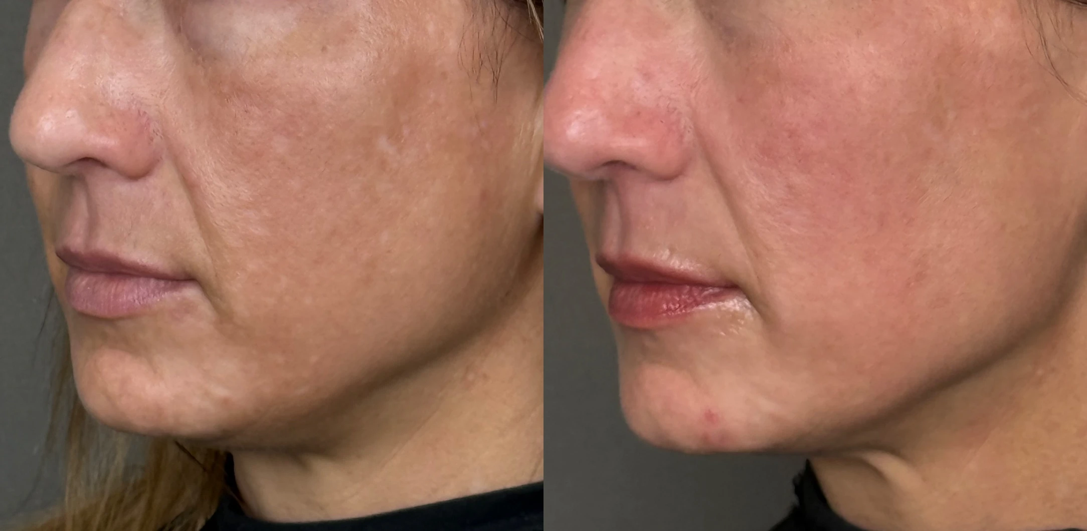 SkinPen Microneedling Before and After Images - 8 SkinPen Face