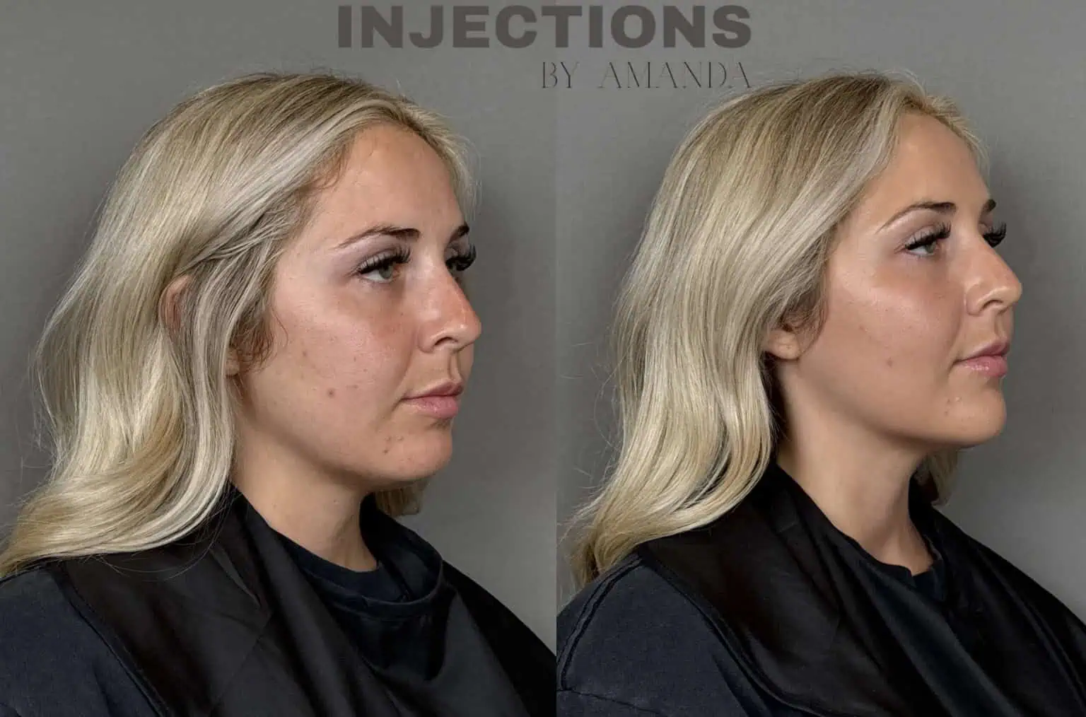 Chin Filler Before and After Images - 2 Untitled design (1)