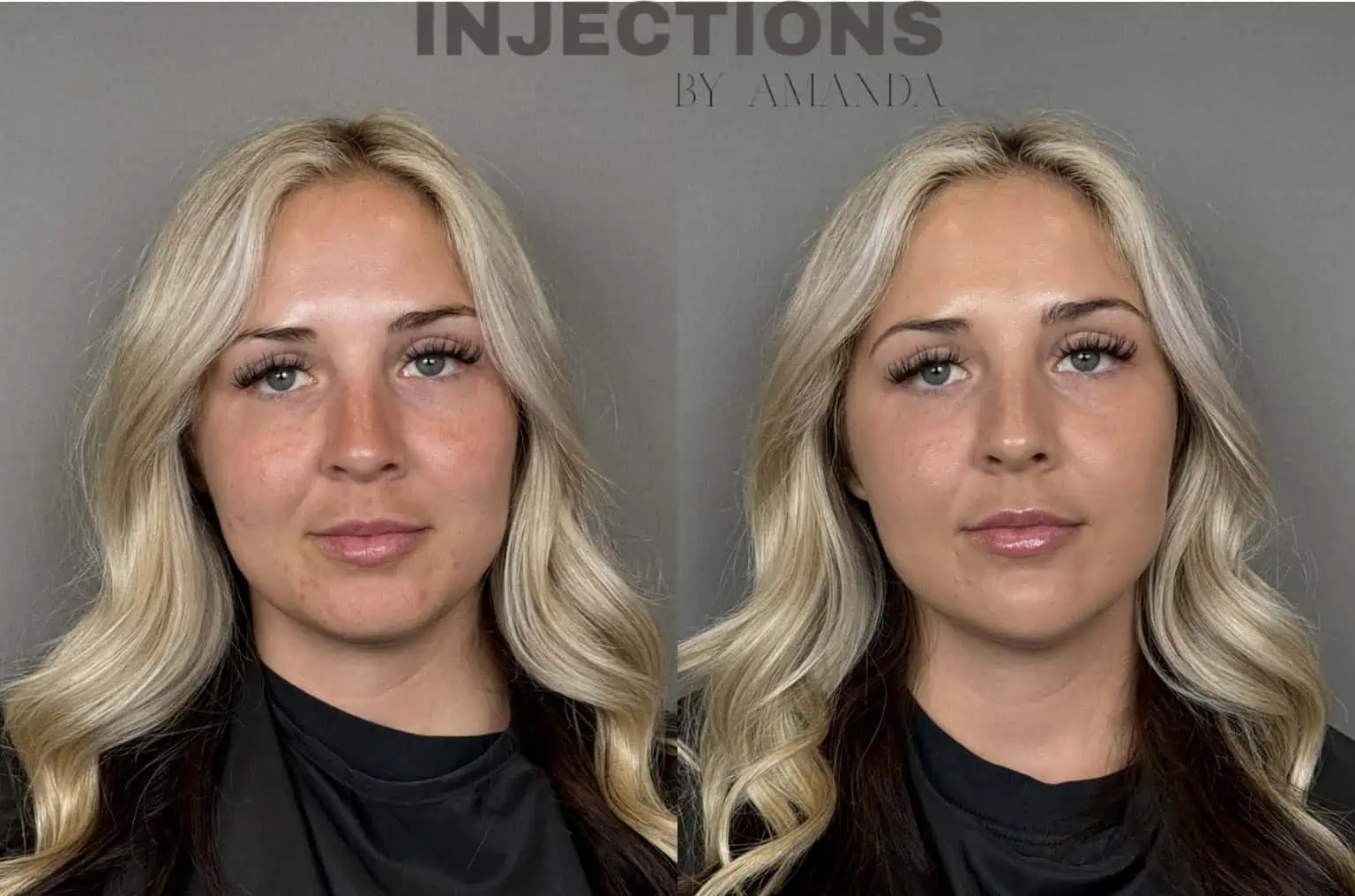 Chin Filler Before and After Images - 1 Untitled design (2)