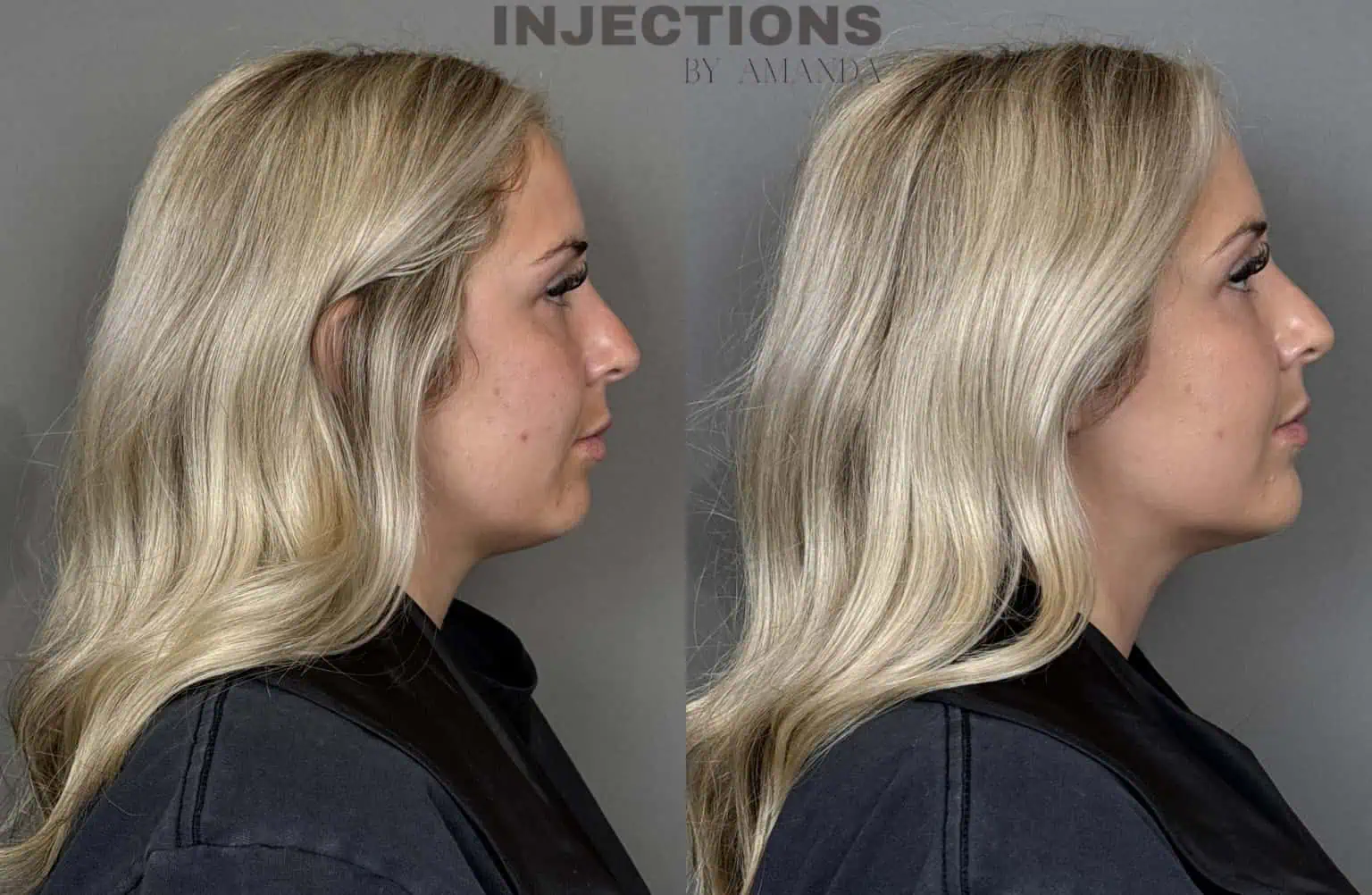 Chin Filler Before and After Images - 3 Untitled design