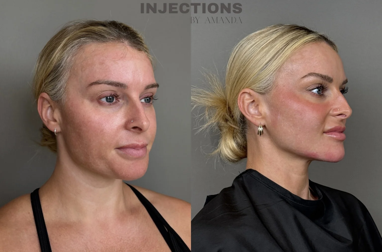 Chin Filler Before and After Images - 1 Chin Filler24