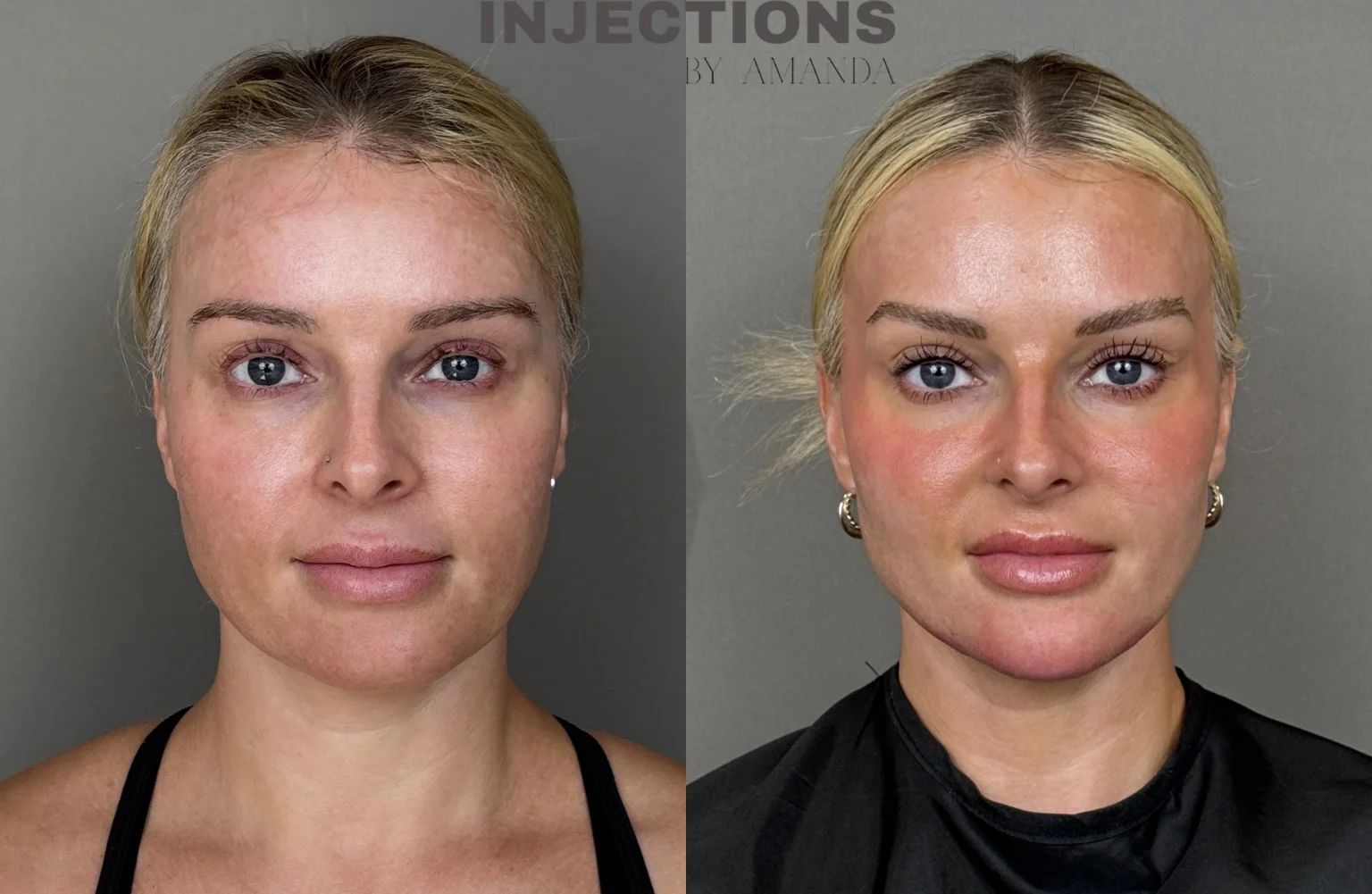 Chin Filler Before and After Images - 2 Chin Filler25