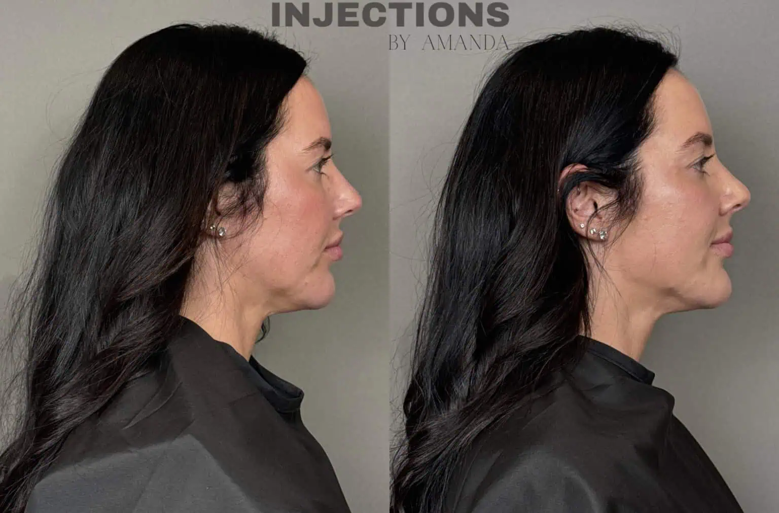 Facial Harmony Trio Before and After Images - 33 Facial Harmony Trio (1)